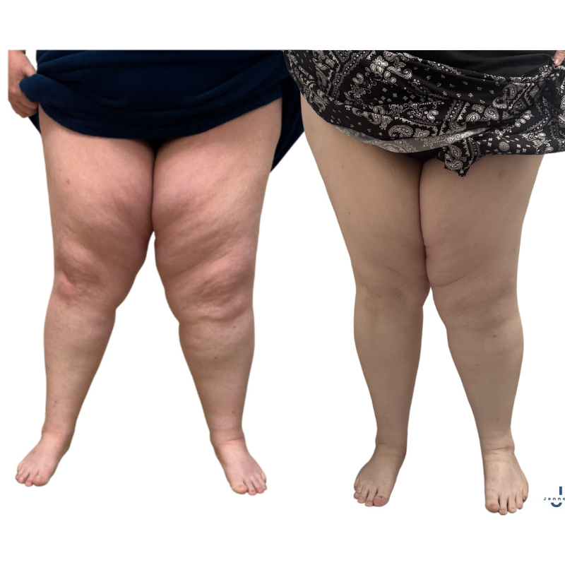 the_lipoedema_clinic_cape_town_patient_review_pic