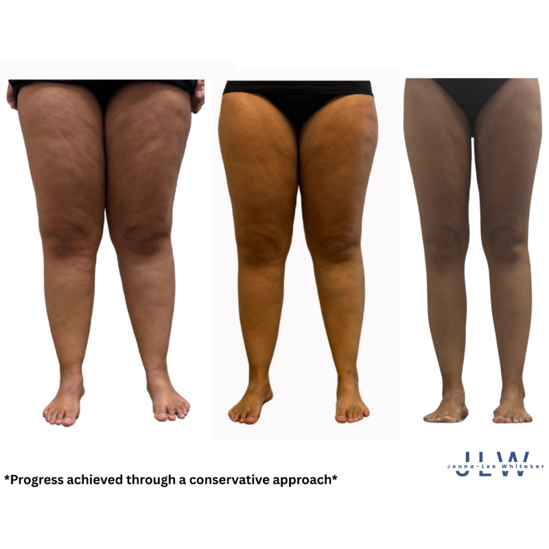 the_lipoedema_clinic_cape_town_patient_review_pic_more