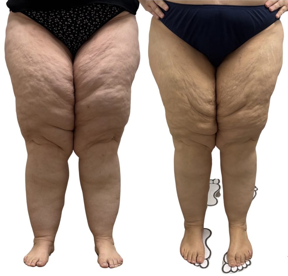the_lipoedema_clinic_cape_town_patient_reviews